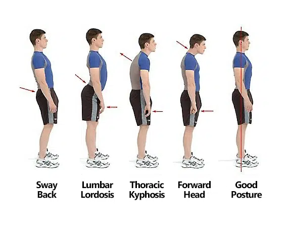 Common body types as a result of bad posture, chiropractic care for posture