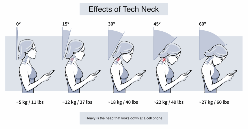 Stiff neck & the effects of Tech Neck